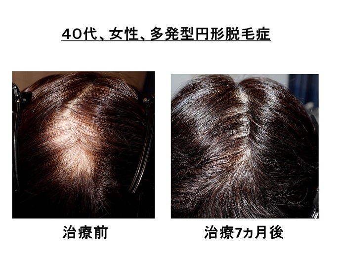 円形脱毛症　病院